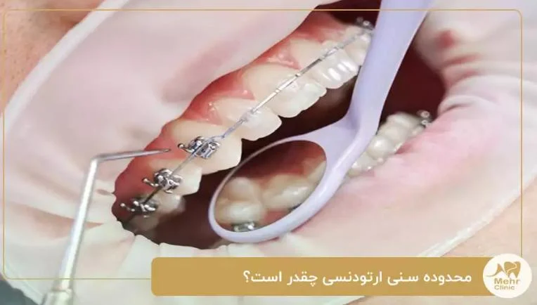 محدوده سنی ارتودنسی چند سال؟ به نقل از متخصصان کلینیک دندانپزشکی مهر شریعتی