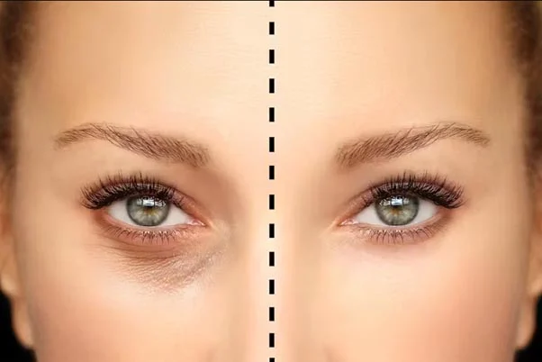 مراقبت‌های کلیدی پس از بلفاروپلاستی پلک پایین برای بهبودی سریع و ایمن