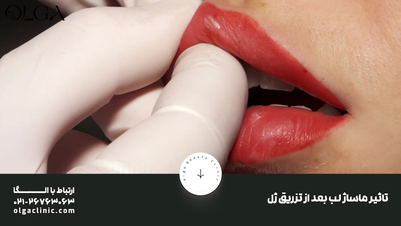 تاثیر ماساژ لب بعد از تزریق ژل